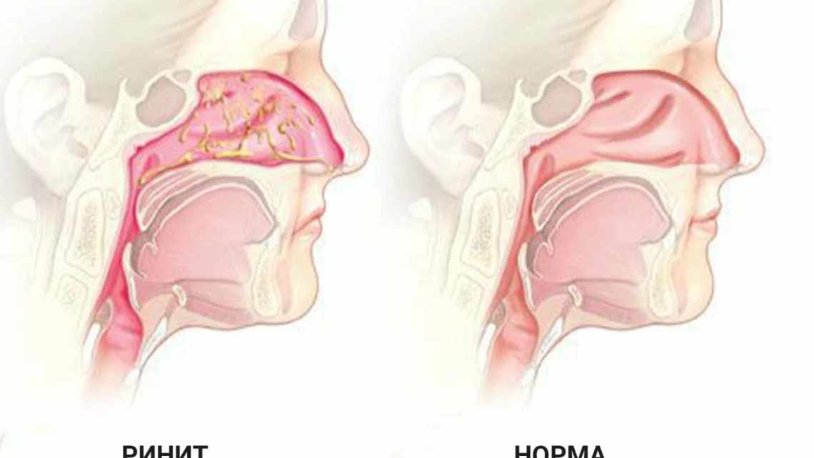 Рініт - причини, симптоми, діагностика, лікування