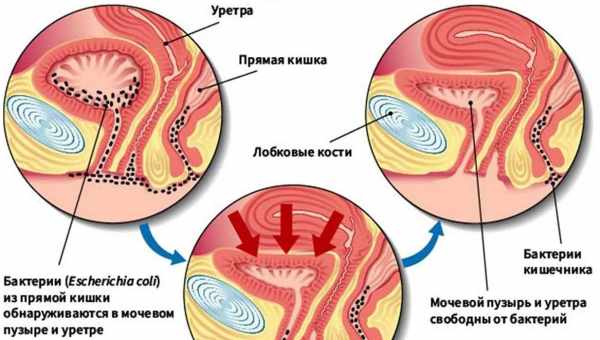 Профілактика ІППП при незахищеному статевому акті