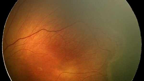 Що таке ретинопатія недоношених?