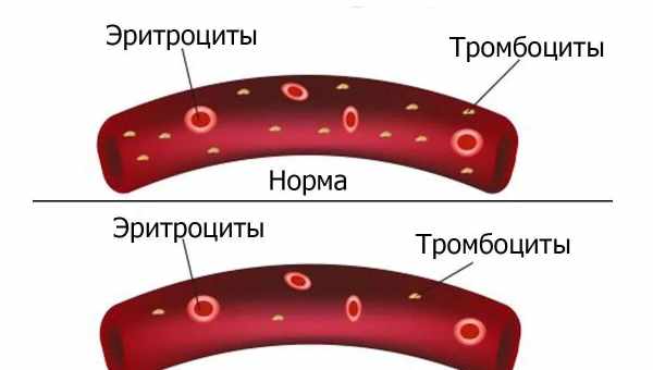 Тромбоцитопіння у дітей: симптоми і підходи до терапії