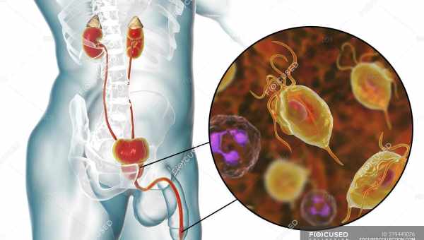 Тріхомонада у жінок: симптоми, діагностика та лікування