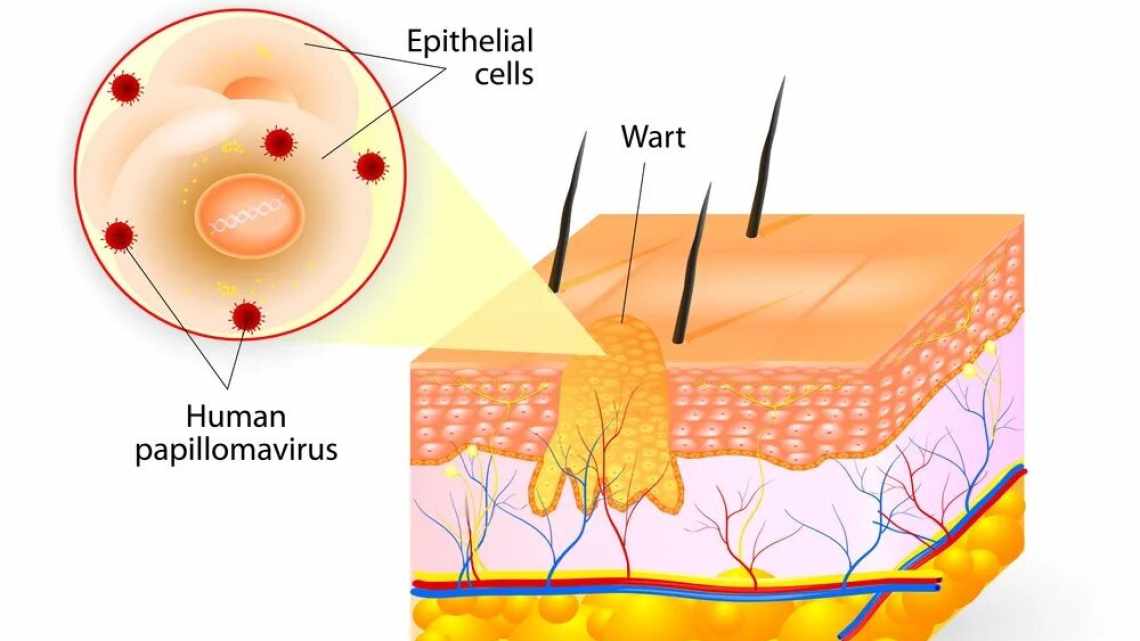 Причини та методи лікування гостроконечних кондилом у жінки
