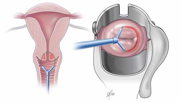 Види коагуляцій шийки матки: показання та протипоказання, реабілітація
