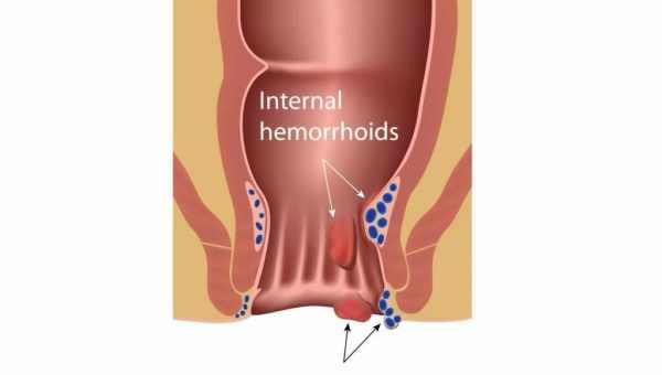 Геморой у дітей: симптоми і лікування