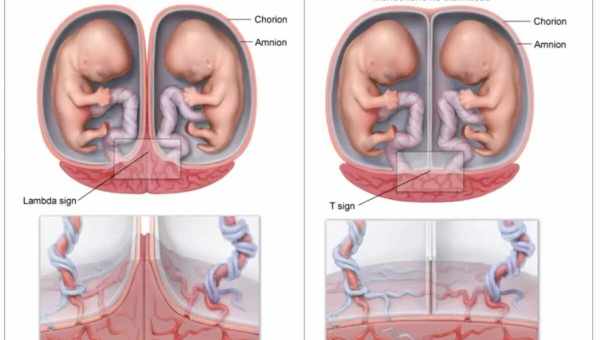 Що таке монохоріальна діамніотична двійня