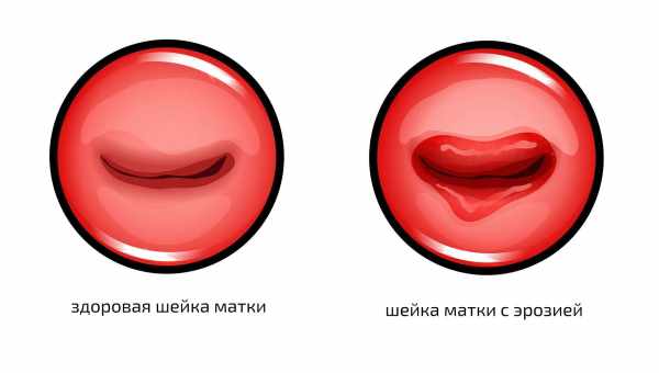 Причини та методи лікування наботових кіст шийки матки