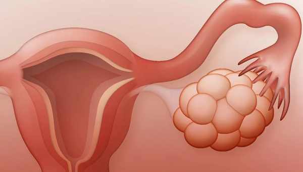 Симптоми і лікування розриву кісти яєчника у жінок