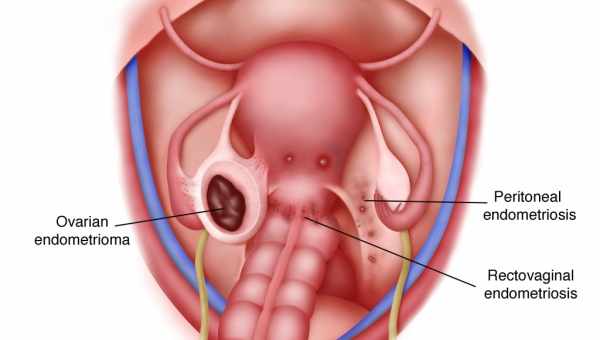 Симптоми, лікування та класифікація ретроцервікального ендометріозу