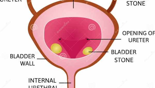 Симптоми і лікування опущення сечового міхура у жінок