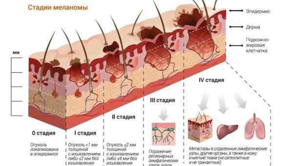 Не помічають: 6 неочевидних місць, в яких ховається меланома