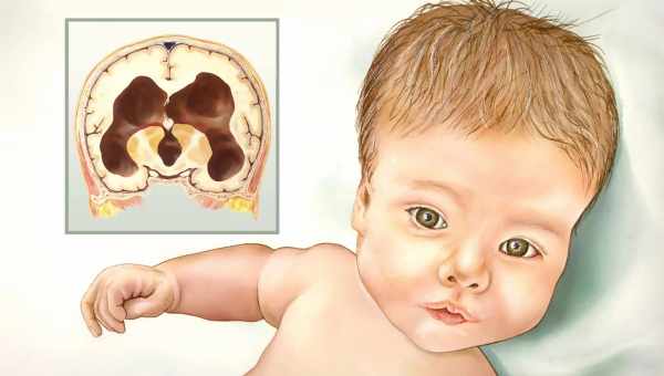 Лікування від гідроцефалії перетворило череп дитини на "роги Диявола" "