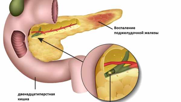 Панкреатит - причини, симптоми, діагностика, лікування