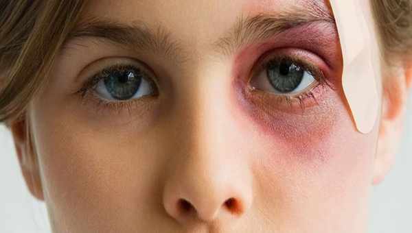 Забій ока: це дуже небезпечна травма! Як лікувати забій ока, які симптоми показують, що потрібна допомога лікаря?