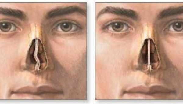Як розпізнати забій носа і ознаки ускладнень травми. Методи першої допомоги та лікування при забої носа
