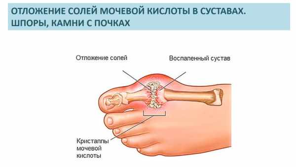 Подагра - лікування в домашніх умовах: чи є воно ефективним або приносить тільки шкоду? Як лікувати подагру вдома