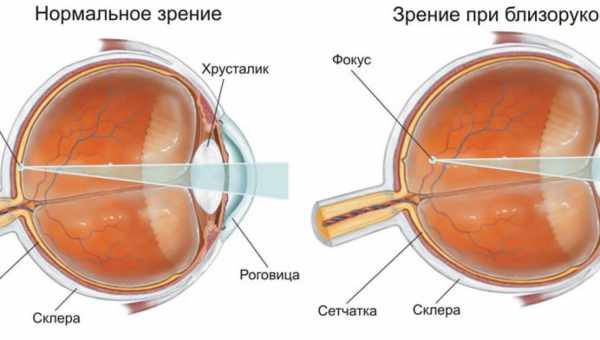 Міопія (короткозорість) - причини, симптоми, діагностика, лікування