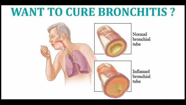 Бронхіт - причини, симптоми, діагностика, лікування
