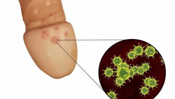Баланопостіт - причини, симптоми, діагностика, лікування