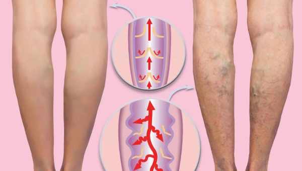 Як лікувати варикоз у домашніх умовах? Чим небезпечне дане захворювання, чи можна запобігти появі варикозу