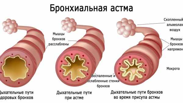 Спазм бронхів: що сприяє розвитку захворювання? Як самостійно допомогти при спазмі бронхів у дорослого і дитини