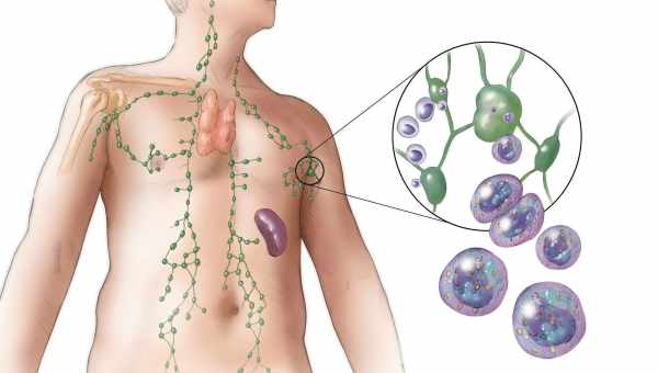 Лімфома - причини, симптоми, діагностика, лікування