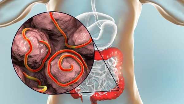 Глисти - причини, симптоми, діагностика, лікування