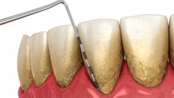 Пародонтоз: лікувати в домашніх умовах складно, але можна! Правила і секрети лікування пародонтозу в домашніх умовах