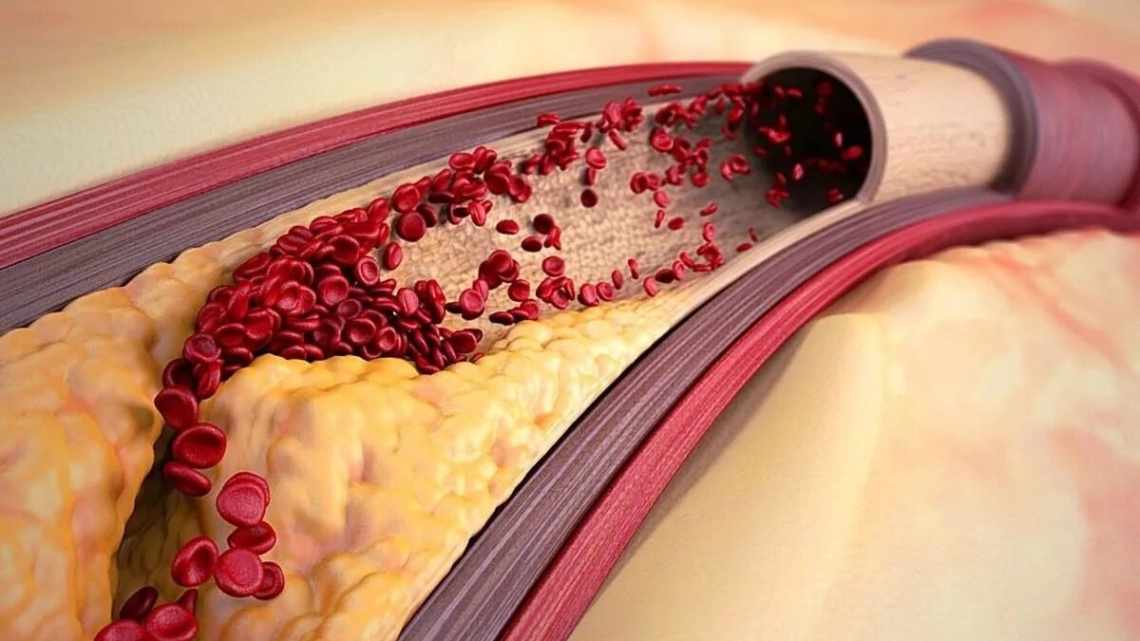 Що пропонує народна медицина від холестеринових бляшок. Чистка судин народними засобами: точно не стане гірше?