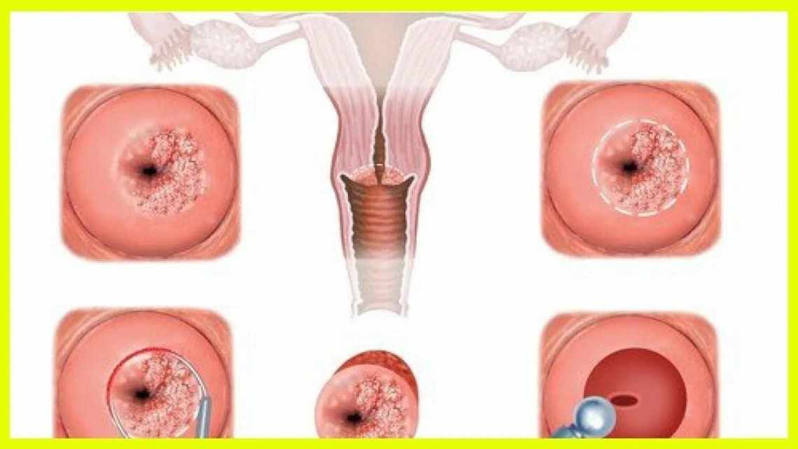 Ерозія шийки матки: лікування народними засобами можливе? Як «працюють» народні засоби лікування ерозії шийки матки