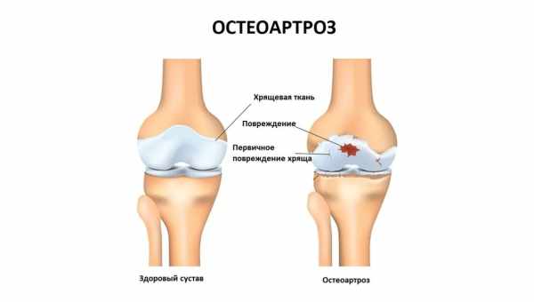 Наскільки ефективно лікувати артроз народними засобами? Вивчаємо рецепти лікування артозу народними засобами