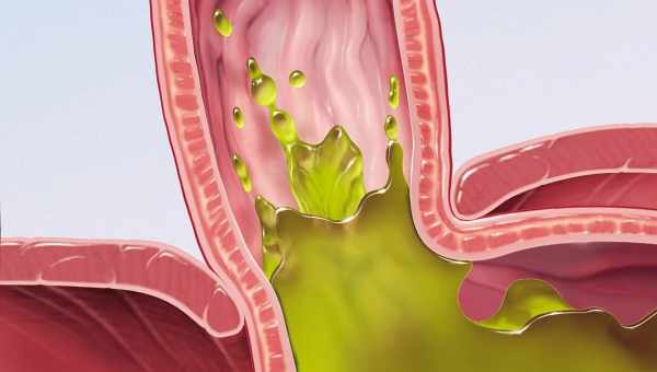 Гастроезофагеальна рефлюксна хвороба - підступний ворог