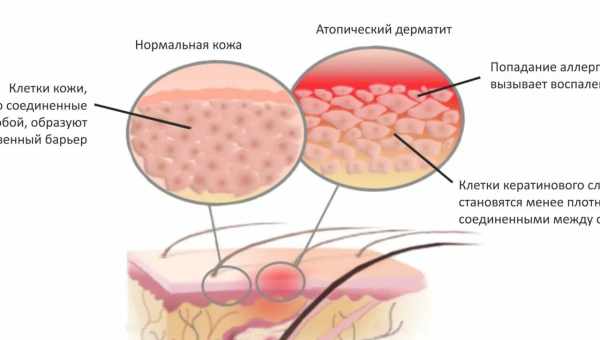 Причини атопічного дерматиту