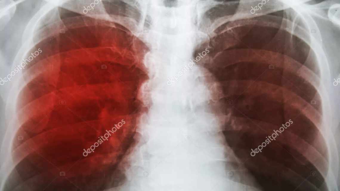 Кошти з алое при туберкульозі легенів. Рецепти складів з медом, маслом, какао та іншими інгредієнтами